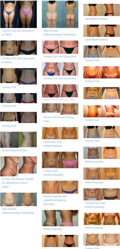 Tummy Tuck Before and After Pictures